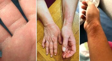 Coronavirus : les soignants montrent leurs mains déshydratées